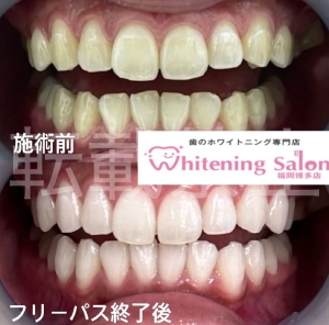 【歯の変色】福岡博多/ホワイトニング