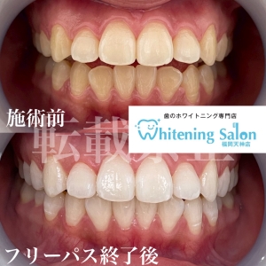 【お茶の着色汚れ】福岡/ホワイトニング