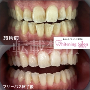 【酸蝕歯とは？】博多/ホワイトニング