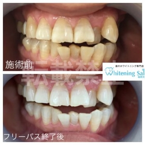 【マウスウォッシュ】天神/ホワイトニング