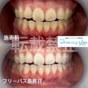 【メンテナンス】天神/ホワイトニング