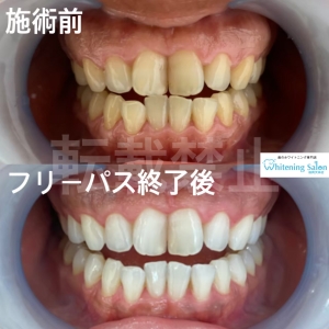 【ホワイトニングの種類】福岡天神/ホワイトニング