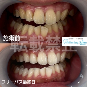 【知覚過敏】ホワイトニング/天神