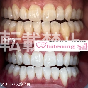 【唾液の働き】福岡博多/ホワイトニング