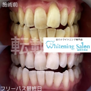 【下の歯が着色しやすい】福岡天神/ホワイトニング
