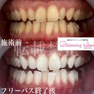 【歯周病と歯肉炎】