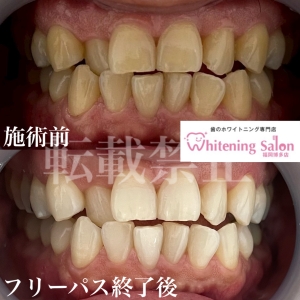 【埋伏歯】福岡/博多/ホワイトニング