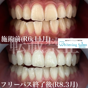 【洗口液のフッ素が良い理由】福岡/天神/ホワイトニング