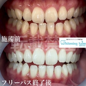 【舌もむくむ】天神/ホワイトニング