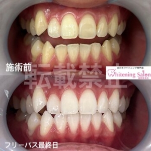 【早期矯正のメリット】博多/ホワイトニング