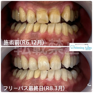 【フッ素洗口について】天神/ホワイトニング