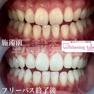 【ドライソケット】福岡博多/ホワイトニング