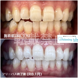 【ドライソケット】福岡天神/ホワイトニング