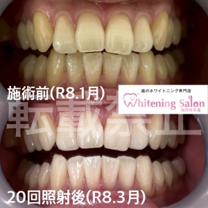 【茶渋が歯につく原因】福岡博多/ホワイトニング